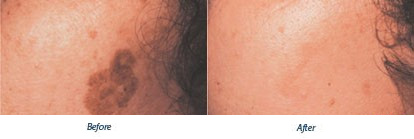 Jane - Before & After